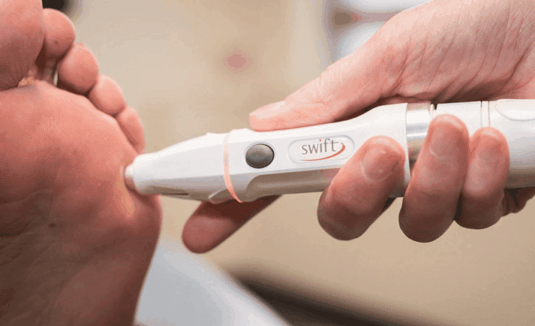 Explore professional plantar wart treatment options including cryotherapy, microwave therapy, needling and topical treatments. Learn what works and why.